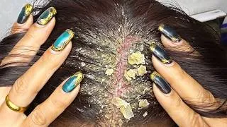 Thumbnail: ASMR with Scalp Scratching #DKMO38005
