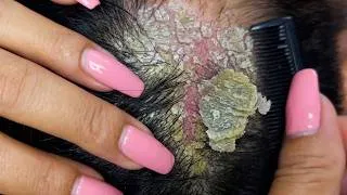 Thumbnail: ASMR Deep Scalp Massage & Hair Scratching #DKMOR38004