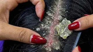 Thumbnail: ASMR with Scalp Scratching #DKMOR38003