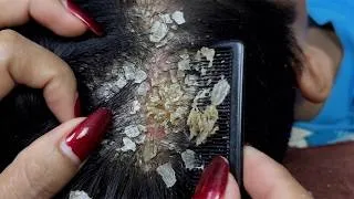 Thumbnail: ASMR Deep Scalp Massage & Hair Scratching #DKMOR38002
