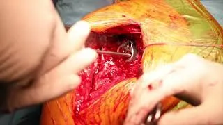 Thumbnail: Mathys: Affinis Fracture Inverse surgery