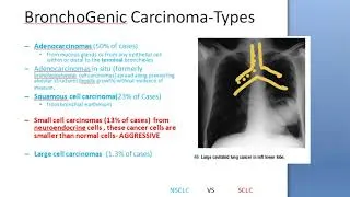 Thumbnail: Medicine Bronchogenic Carcinoma Lung Cancer NSCLC Small cell PYQ