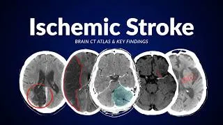 Thumbnail: Ischemic Stroke: Brain CT Atlas & Key Findings