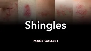 Thumbnail: Shingles (Herpes Zoster): Image Gallery