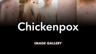 Thumbnail: Chickenpox: Image Gallery