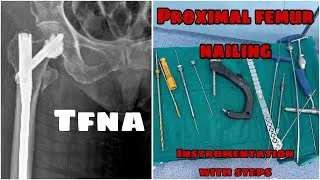 Thumbnail: Proximal Femur Nailing Instrumentation || PFN || TFNA 