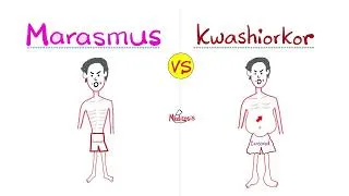 Thumbnail: Marasmus vs. Kwashiorkor - Protein Energy Malnutrition - Gastroenterology
