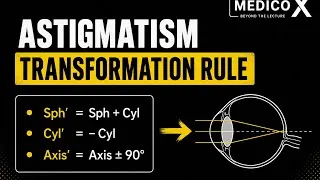 Thumbnail: Transformation Rule for Astigmatism #neetpg 