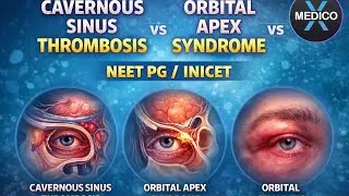 Thumbnail: CAVERNOUS SINUS THROMBOSIS vs ORBITAL APEX SYNDROME vs ORBITAL CELLULITIS for NEETPG/INICET | brief 