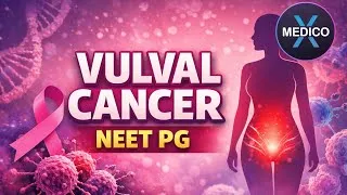 Thumbnail: Vulval Cancer explained briefly for NEET PG & INI-CET | Female Cancer