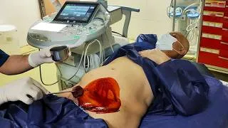 Thumbnail: Inguinal Mass Biopsy | Ultrasound-Guided Diagnostic Procedure