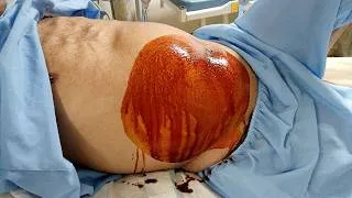 Thumbnail: Ultrasound-Guided Peritoneal Catheter Insertion for Recurrent Ascites