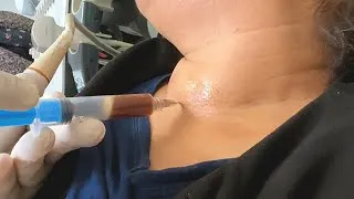 Thumbnail: Thyroid Abscess Drainage Under Ultrasound