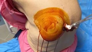 Thumbnail: Thoracentesis of (500cc) Pleural effusion - A Patient with Liver Cancer