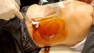 Thumbnail: Remove Deep Abdominal Abscess with Ultrasound Guidance - Seldinger Technique