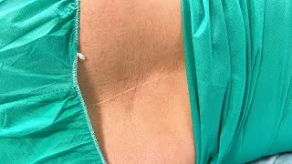 Thumbnail: How to Perform Lumbar Puncture? - Ruling out Meningitis