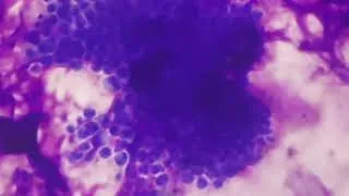 Thumbnail: Yeasts cells in BAL Giems staining