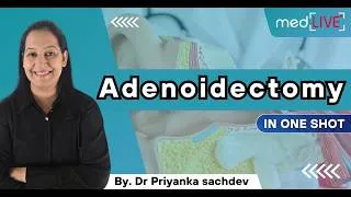 Thumbnail: Adenoid Facies & Adenoidectomy - High Yield ENT for NEET PG & FMGE