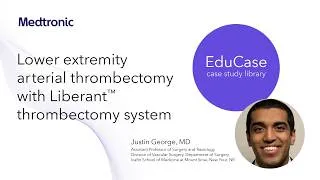 Thumbnail: Lower extremity arterial thrombectomy with Liberant™ thrombectomy system