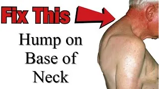 Thumbnail: How To Reduce The Hump On My Back- Ask A Physio