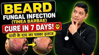 Thumbnail: Beard Fungal Infection (Tinea Barbae) Cure in 7 Days! Homeopathic Medicines for Beard Ringworm