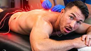 Thumbnail: We Tried Dry Needling