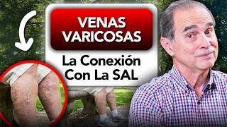 Thumbnail: VENAS VARICOSAS: La Conexión Con La SAL