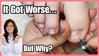 Thumbnail: She Covered Her Damaged Big Toenails for a Wedding… Here’s What Happened