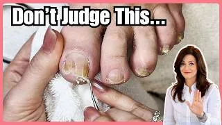 Thumbnail: Why Do People Let Toenails Get This Bad? Here’s the Truth