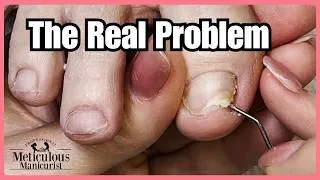 Thumbnail: She Thought Her Toenails Were Ruined… Until We Found the Real Problem