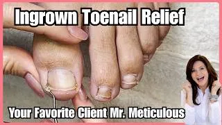 Thumbnail: Does It Hurt? Cleaning Mr  Meticulous’s Impacted Toenails