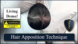 Thumbnail: Hair Apposition Technique for closing Scalp Lacerations - Living HD Demo!