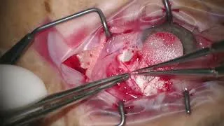 Thumbnail: Moran Eye Core - Tube Extension with Crawford Stent