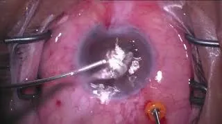 Thumbnail: Moran Eye Core - IZHV Surgical Technique and Settings
