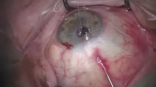 Thumbnail: Bleb Revision MVR Voiceover