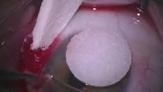 Thumbnail: Surgical Pterygium Removal with Conjunctival Autograft [ARCHIVE]