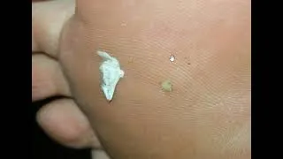 Thumbnail: What Really Happens to your Skin - Morgellons Desease - The silent pandemic   Aspergillus Fumigatus