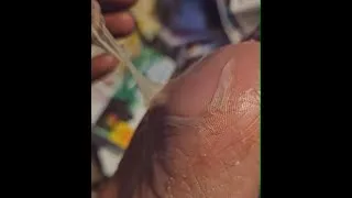 Thumbnail: What to Expect Near the End! - Morgellons Desease  The silent pandemic - Aspergillus Fumigatus