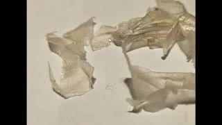Thumbnail: Peeling skin & Why?  - Morgellons Desease - The silent pandemic - Aspergillus Fumigatus