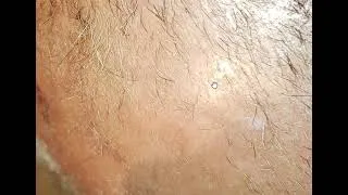 Thumbnail: High Blood Presure - Morgellons Desease - The silent pandemic - Aspergillus Fumigatus