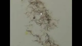 Thumbnail: Skin Problem & The Blob - Morgellons Disease - The silent pandemic - Aspergillus Fumigatus