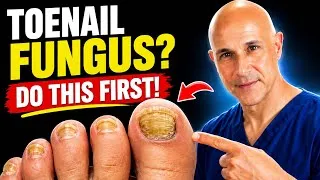 Thumbnail: Before You Treat Toenail Fungus… Watch This | Dr. Mandell
