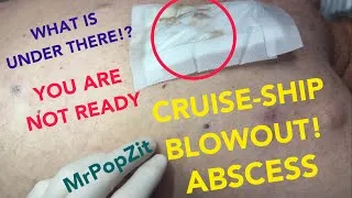 Thumbnail: Cruise ship blowout!When I lifted the bandage I couldn’t believe how much had popped out!Get ready!