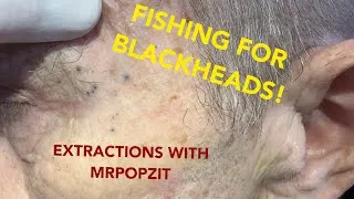 Thumbnail: This one has it all!Blackheads,whiteheads,and a bonus Steatocystoma! See how I change it up!