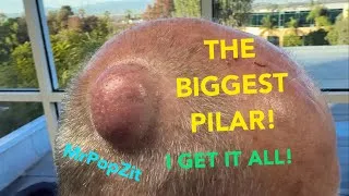 Thumbnail: Gigantic Pilar Cyst! Don’t miss this one, it has it all! Unique secondary encapsulated lining. 