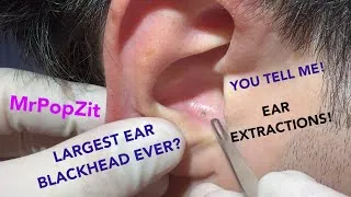 Thumbnail: Giant ear blackheads extracted! There’s one triple pore one pocket! - difficulty level-Wizard