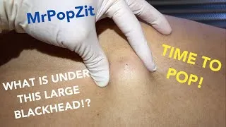 Thumbnail: The Total Flake cyst. See the Fluffy POP! What has grown under that blackhead for all these years!