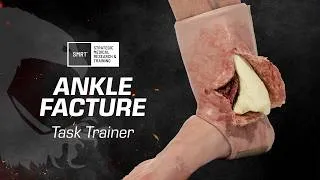 Thumbnail: Manage Extremity Bleeding with the SMRT™ Ankle Fracture