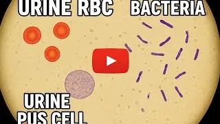 Thumbnail: 🔬 Microscopic view of Urine RBC & Pus Cells | Pathology Lab Test 🧪