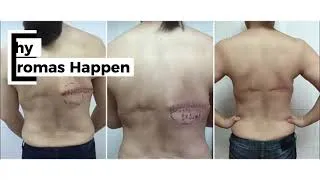 Thumbnail: Cosmetic Surgery Case Files | Seromas
